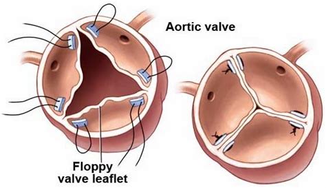 Aortic Valve Repair Replacement And Surgery