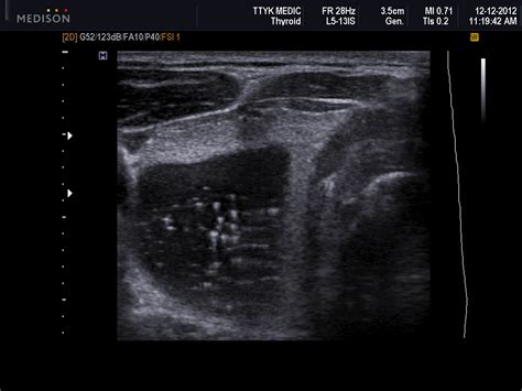 VIETNAMESE MEDIC ULTRASOUND: CASE 157: THYROID CYST with COMET TAIL ...