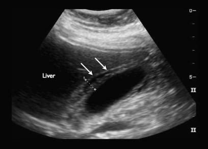 Bedside Ultrasound Diagnosis of Acalculous Cholecystitis from Ebstein ...