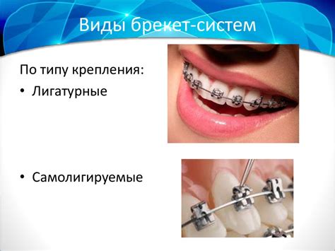 Сравнение лигатурных и самолигируемых брекет-систем - презентация онлайн