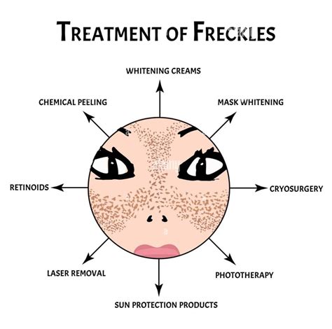 Freckles: Some Best 12 Natural Treatments