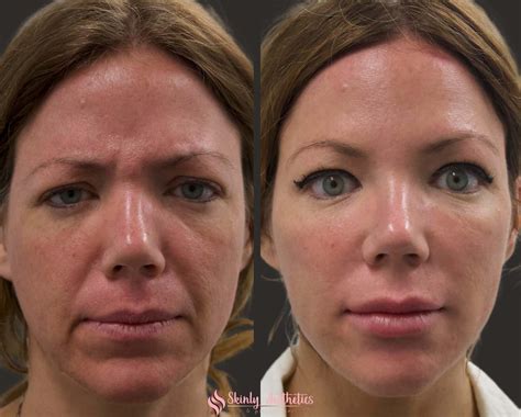 Juvederm Cheeks Before And After Photos