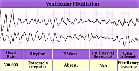 Atrial Fibrillation Vs Atrial Flutter