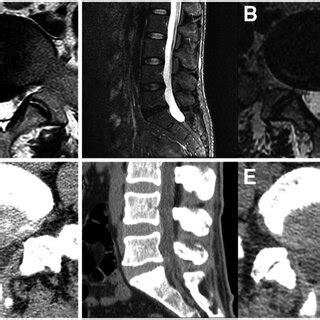 Percutaneous Endoscopic Lumbar Discectomy Via The Interlaminar Approach