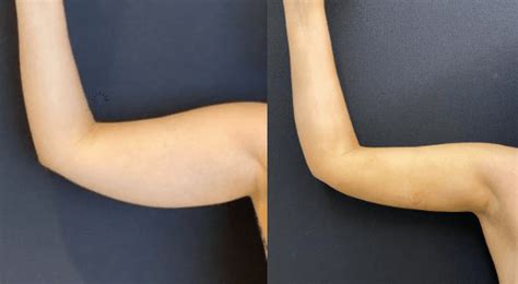 Before After Arms Liposuction Neinstein Plastic Surgery