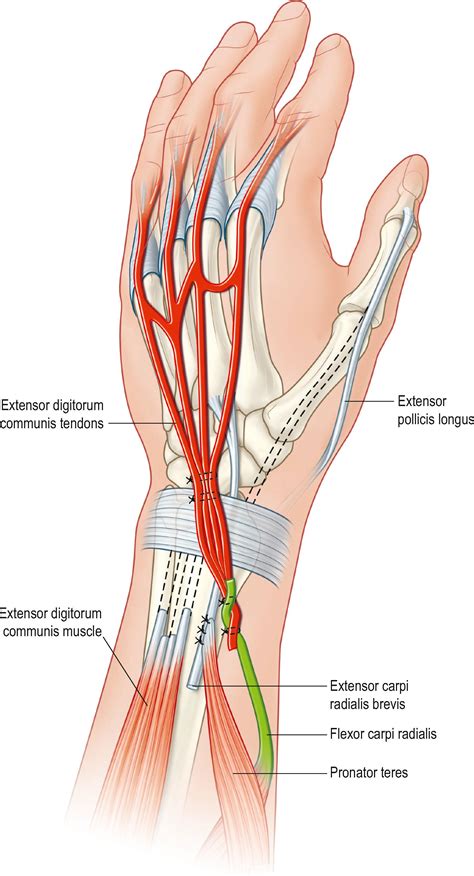 Tendon Transfers Clinical Tree