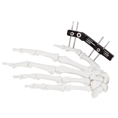 Mini Fragment External Fixator (Finger and Palm) - Orthopromed Inc.