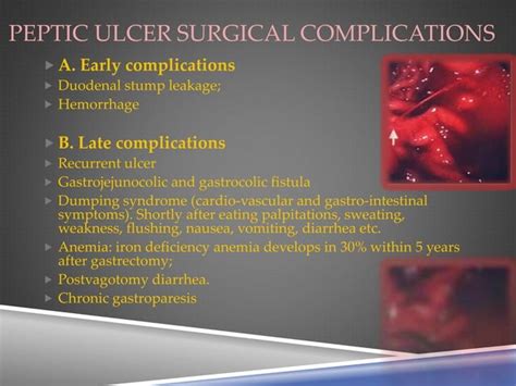 Peptic Ulcer Complications | PPT