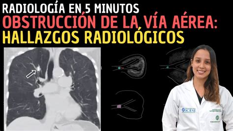 Radiolog A En Minutos Obstrucci N De La V A A Rea Hallazgos