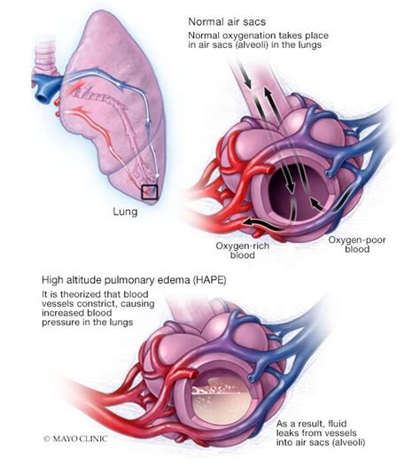 Pulmonary Edema: Causes, Symptoms, Diagnosis Treatment, 51% OFF