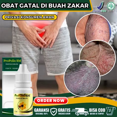 Jual Obat Oles Gatal Buah Zakar Pria Alami Obat Lecet Di Buah