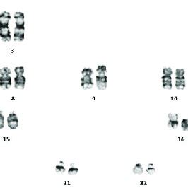 Cytogenetic analysis showing chromosomal translocation... | Download ...