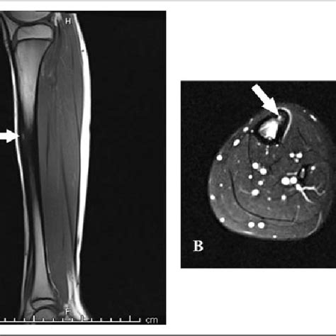 A T1 Sag B Axial T2 Fat Saturated Magnetic Resonance Imaging Of