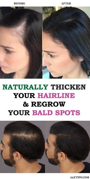 Naturally Thicken Your Hair Line And Regrow Bald Spots Regrow Hair