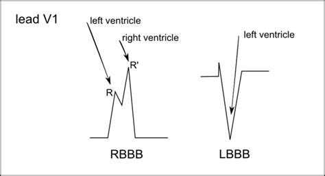 Bundle Branch Blocks 101 REBEL EM Emergency Medicine Blog