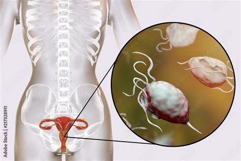 Female Trichomoniasis D Illustration Showing Vaginitis And Close Up