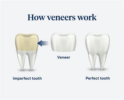 Dental Veneers Pros And Cons Aspen Dental