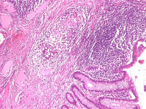 Tuberculous Nodule Presenting In The Appendicular Submucosa He