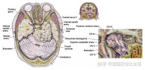 岩斜区脑膜瘤手术成功率高吗？手术6大难点、4大手术入路 知乎