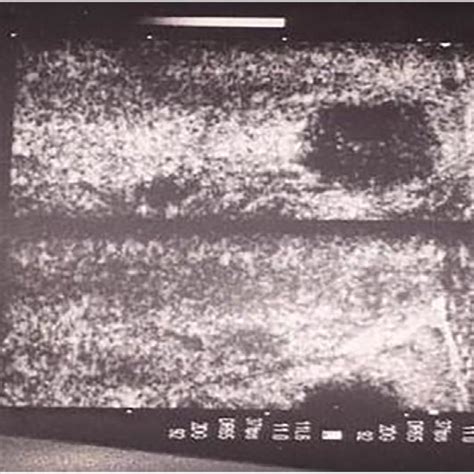 Mri Neck T1 And T2 Axial Images Show A Multilocular Cystic Lesion