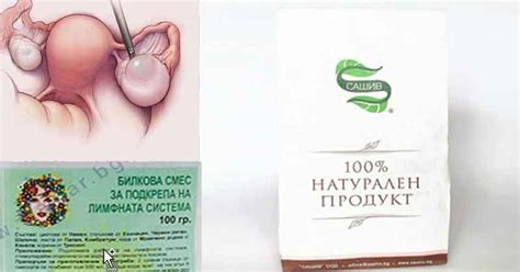 Как излекувах киста на яйчника: Премахване (стопяване) с народна ...