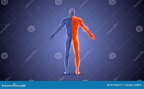 Hemiplegia Paralysis Condition Medical Concept Stock Illustration ...