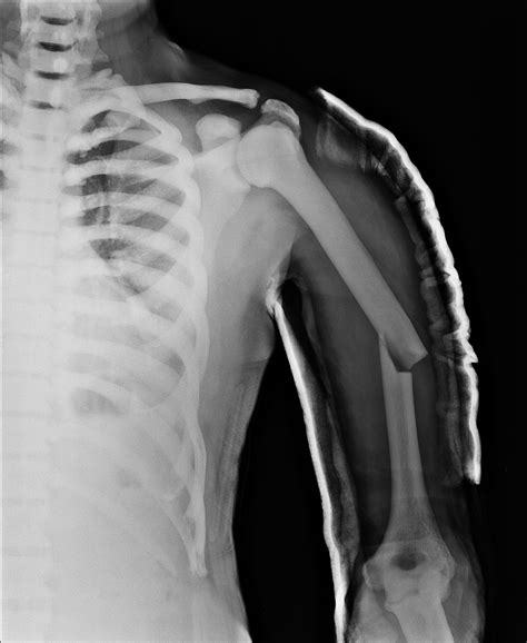 X Ray Image Demonstrating The New Fracture On The Left Humerus And Images