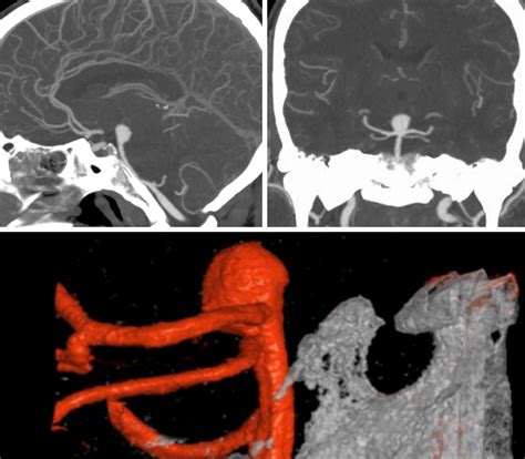 Basilar Aneurysm Pterional Approach The Neurosurgical Atlas By