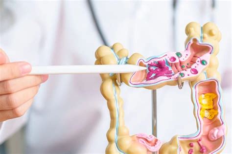 Mortalidade por câncer colorretal cresce na América Latina