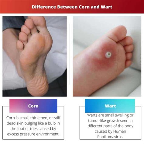 Planters Wart Vs Corn At Anthony Gilkey Blog