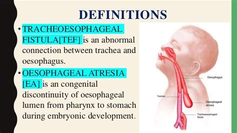 Tracheoesophageal Fistula Ppt