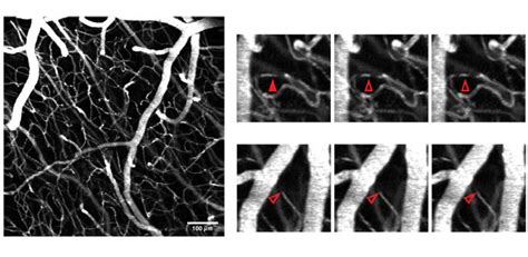 New method for detecting blood circulation problems in brain capillaries