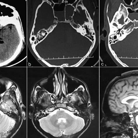 A Ct Head Following Injury Showing Pneumocephalus B Longitudinal