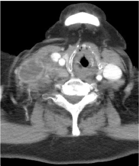 Figure 2 From A Case Of Cervical Lymph Node Tuberculosis And Metastatic