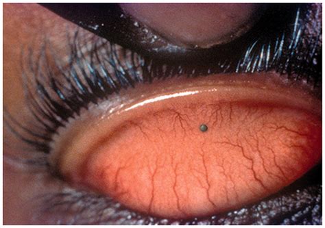 Severe Corneal Abrasion