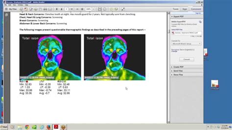 My Thermography Results - YouTube