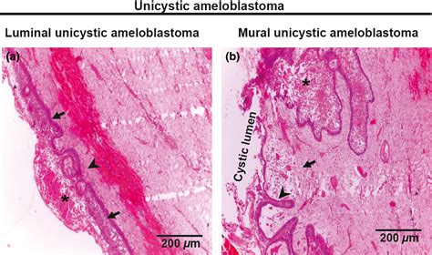 Ameloblastoma Histology