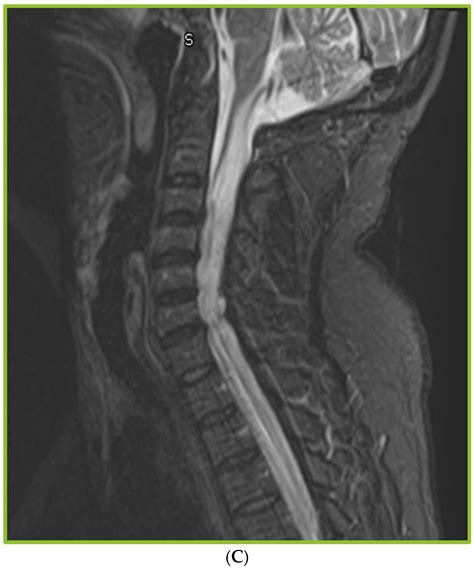 Jof Free Full Text Spinal Arachnoiditis In Patients With Coccidioidomycosis Meningitis