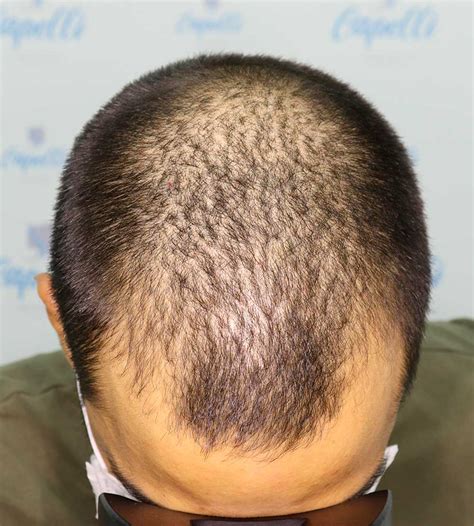 Alopecia Androgenetica Capelli Skin Center