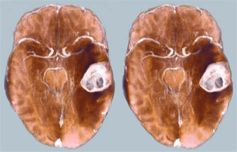 Melanoma Brain Metastasis 2e by voxel123 on DeviantArt