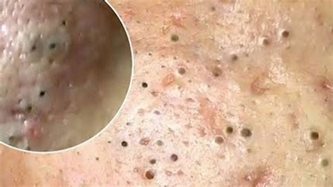 Blackheads And Milia Big Cystic Acne Blackheads Extraction Whiteheads