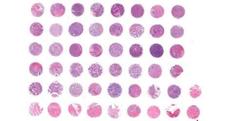 Br501a Breats Cancer And Normal Adjacent And Breast Tissue Array