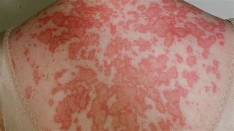 Cutaneous Manifestation Of Systemic Lupus Erythematosus Sle