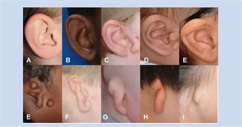 Figure 1 From Microtia Epidemiology And Genetics Semantic Scholar