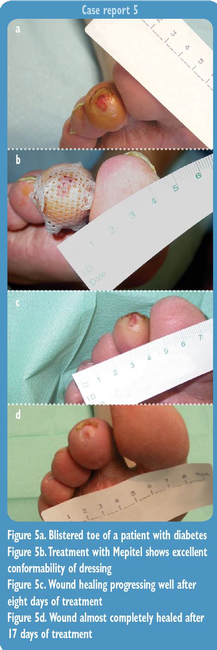 Figure 5 From Management Of Diabetic Foot Ulcers Using Dressings With Safetac ® A Review Of