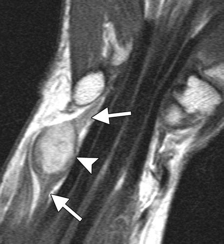 Soft Tissue Tumors And Tumorlike Lesions A Systematic Imaging Approach