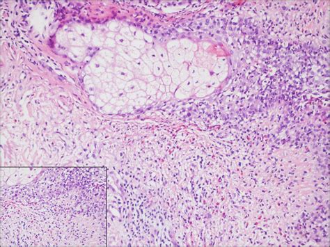 Eosinophilic Pustular Folliculitis Histology