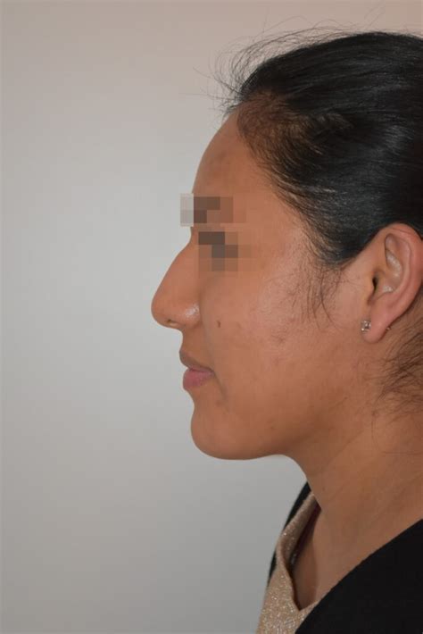 Rhinoplastie Conservatrice ultrasonique avant après