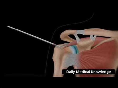 Arthroscopic Rotator Cuff Repair Surgery Animation Youtube