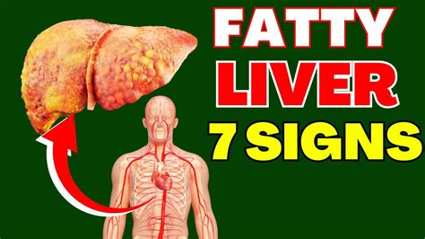 Protect Your Liver Recognizing Fatty Liver Symptoms Youtube